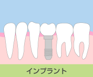 インプラント