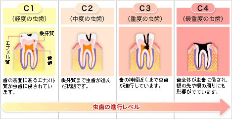 虫歯の進行の様子